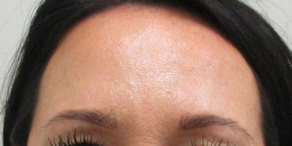 after picture of botox indianapolis