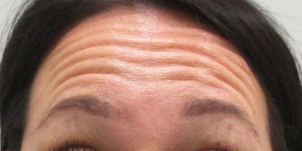 before picture of botox indianapolis