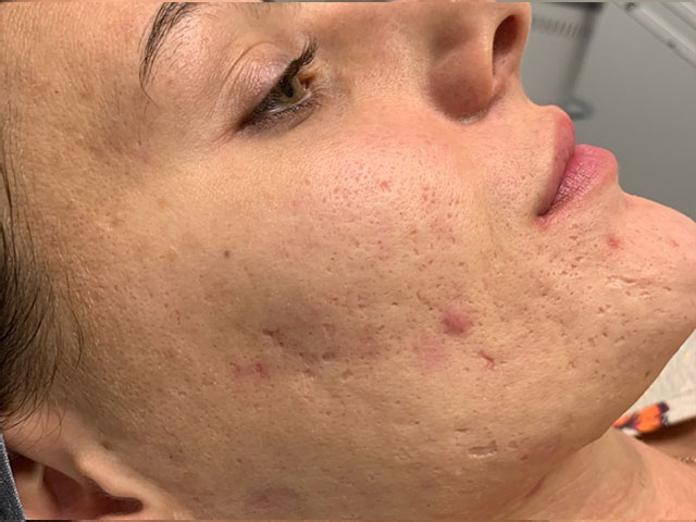 patient before microneedling in Indianapolis.