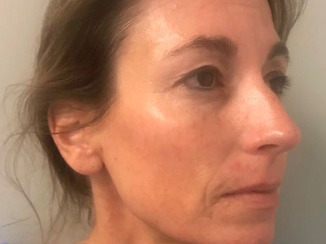 after picture of microneedling indianapolis