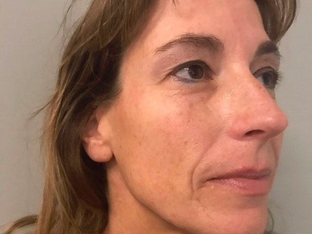 before picture of microneedling indianapolis