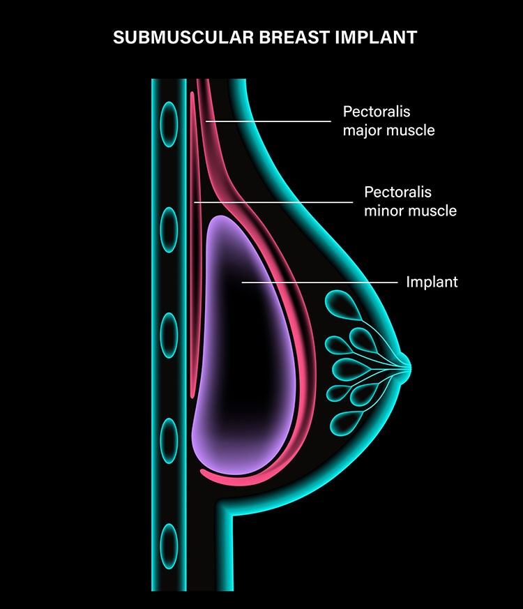 breast augmentation indianapolis illustration