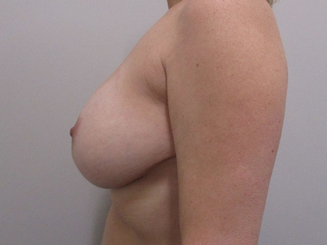 before and after breast lift