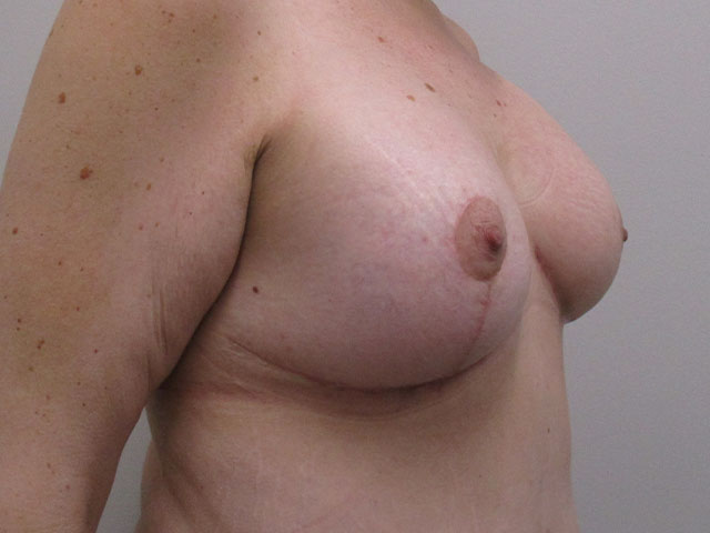 before and after breast lift