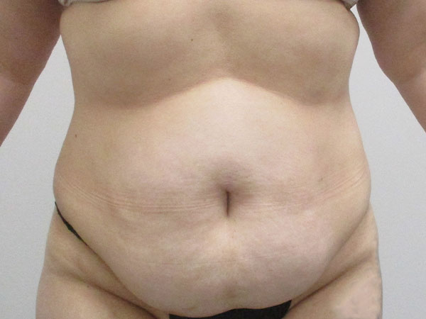 Patient stomach before tummy tuck surgery in Indianapolis, IN