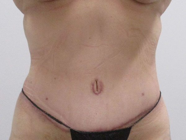 Patient results after tummy tuck at SHarper Plastic and Reconstructive Surgery in Indianapolis, IN