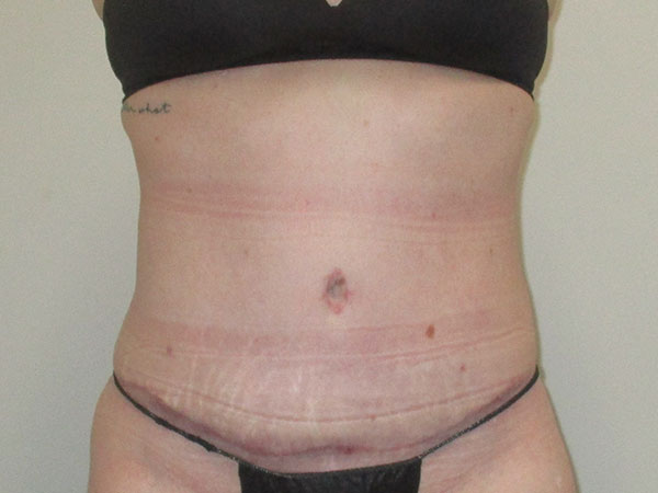 Post-surgery results from tummy tuck in Indianapolis, IN