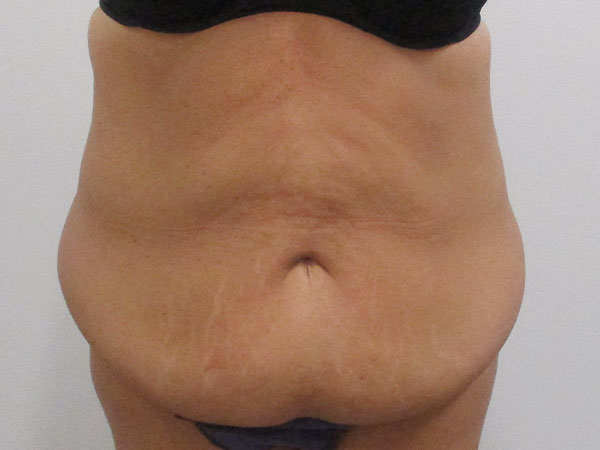 Large pre-op patient stomach before tummy tuck surgery in Indianapolis