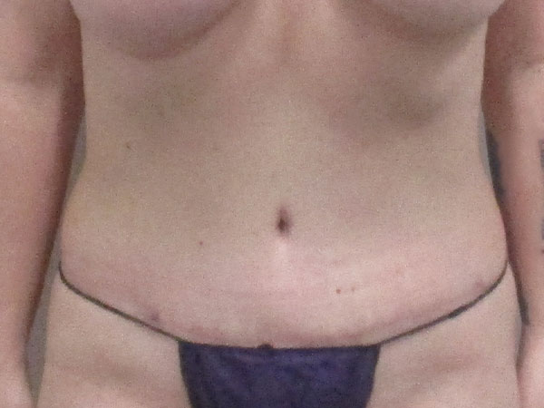 Real patient results from tummy tuck in Indianapolis, IN