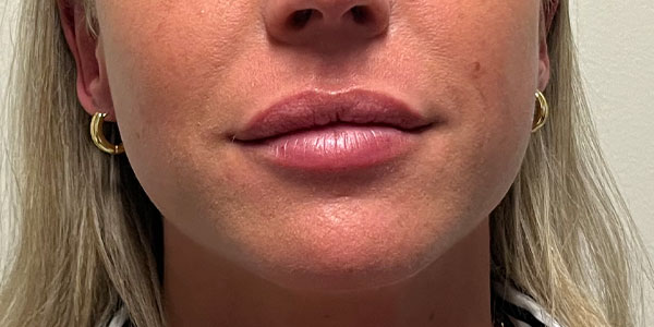 patient after lip fillers in Indianapolis
