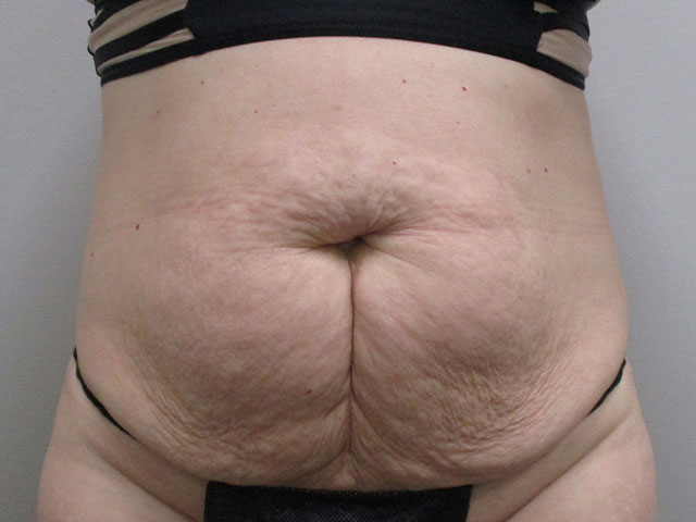 Stomach with extra skin before tummy tuck in Indianapolis