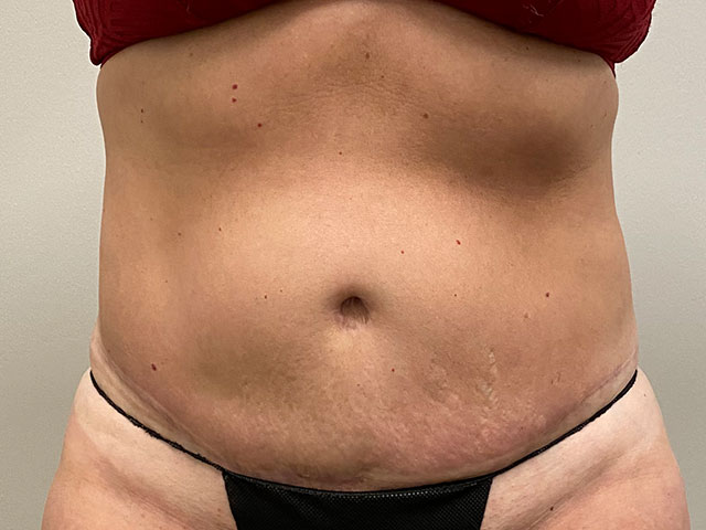 Patient results after tummy tuck surgery in Indianapolis, IN