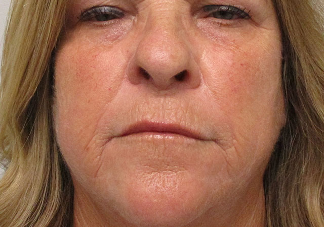 woman after skin tightening in Indianapolis