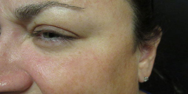 patient after Botox in Indianapolis